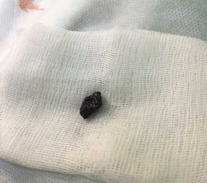 Раненные взрывом гранаты бердянские копы на искусственном дыхании: врачи рассказали подробности (ФОТО)