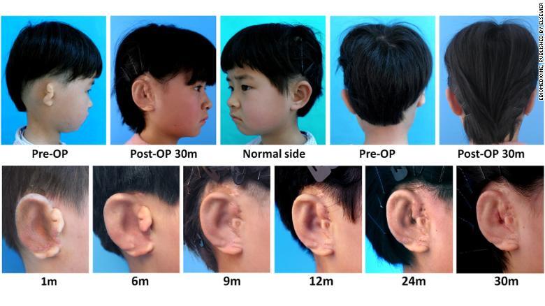 Ученые пересадили детям уши, выращенные в лаборатории. Фотофакт