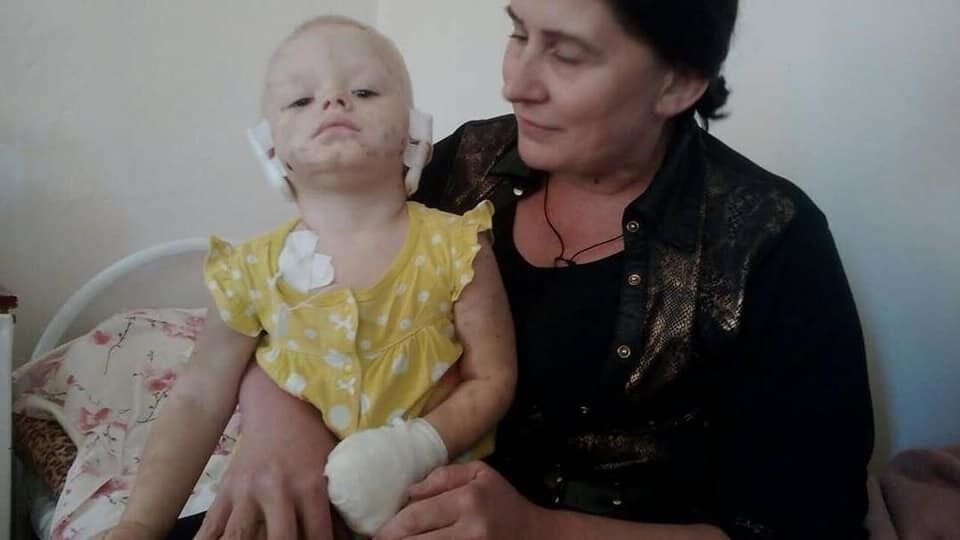 Собака отгрызла уши и пальцы: в Славянске произошло жуткое ЧП с ребенком