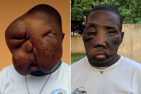 Врачи удалили подростку огромную опухоль на лице: поразительные фото до и после
