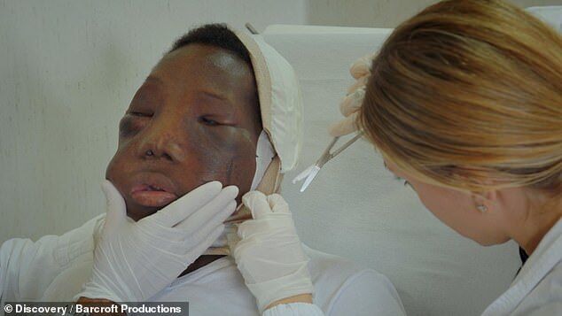 Врачи удалили подростку огромную опухоль на лице: поразительные фото до и после