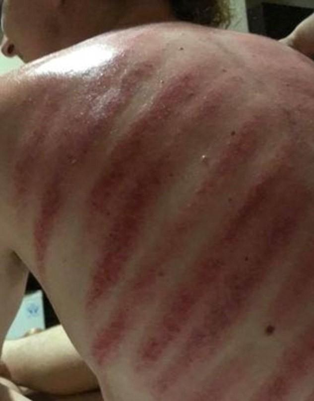 ''Витягнув червоного дракона'': туриста на Балі покалічив масажист
