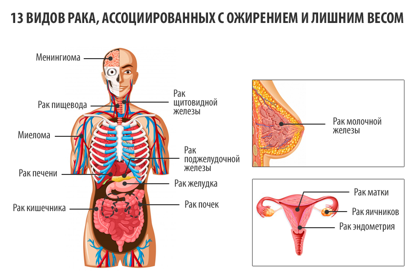 13 видів раку, які виникають через ожиріння