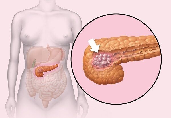 Рак поджелудочной железы