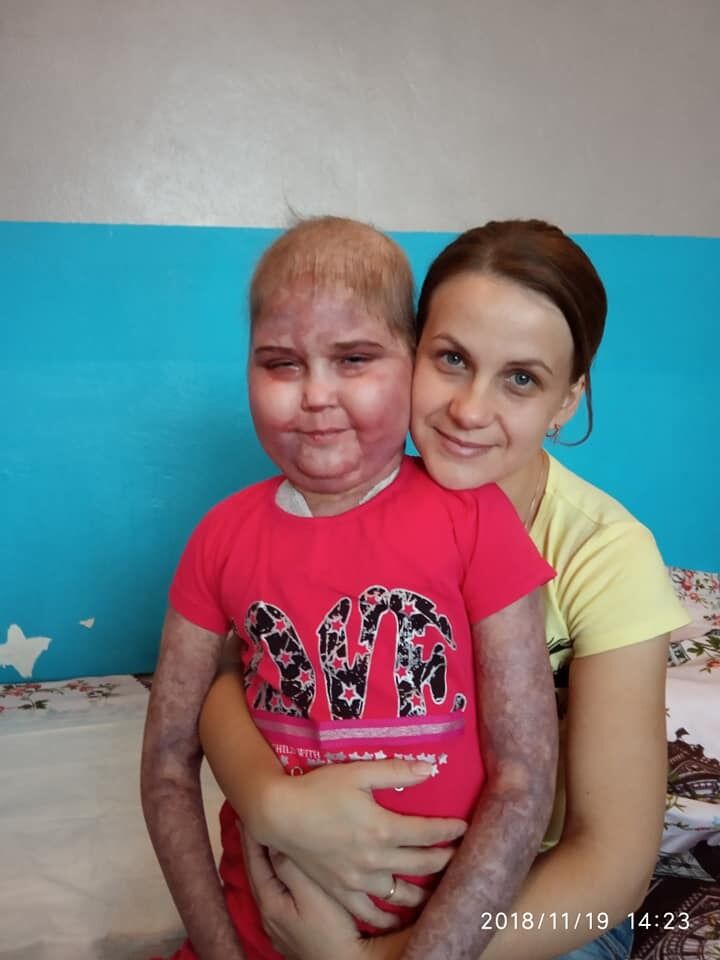 ''Виписали в кривавих бинтах'': в Києві дитину з раком виставляють на вулицю, лікарня заперечує