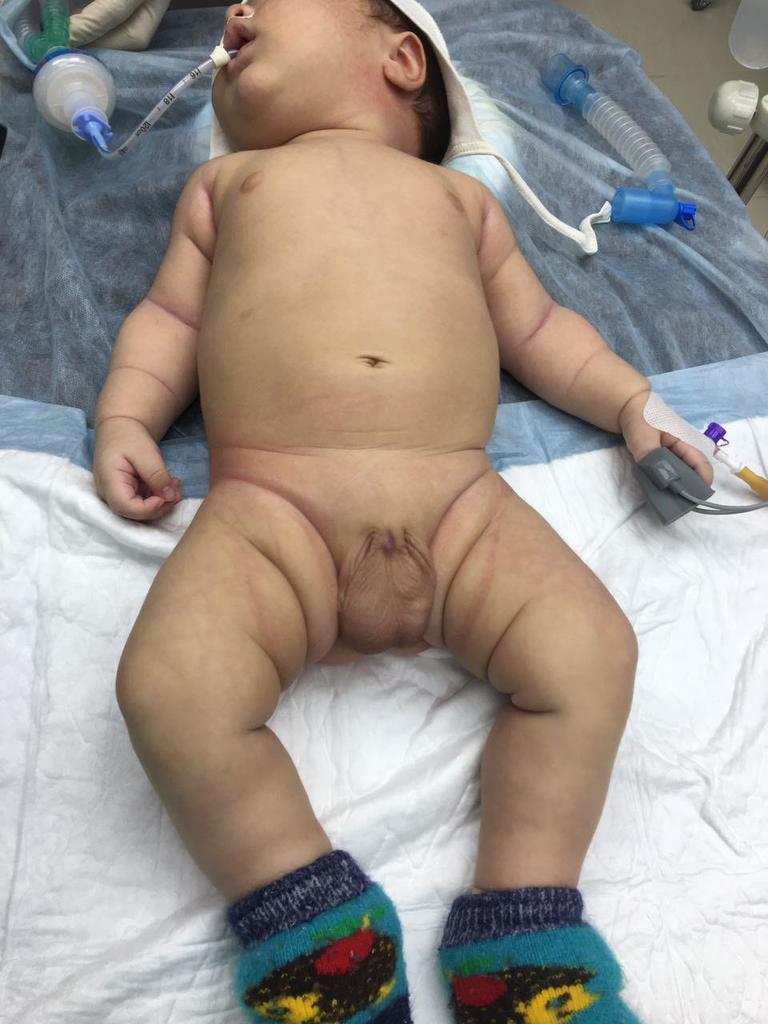 Ребенку чудом спасли половой орган после обрезания. Фото 18+
