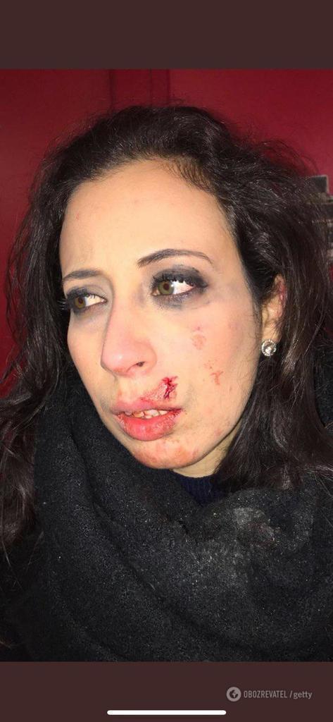 Дівчина заявила, що їй розбили обличчя під час протестів