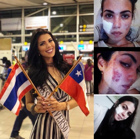 Претендентці на титул "Міс Всесвіту-2018" спалили обличчя кислотою: фото до і після