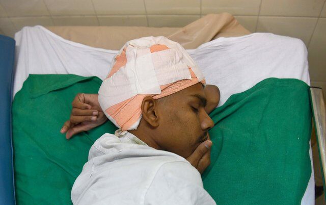 В Индии удалили опухоль мозга размером почти с полголовы