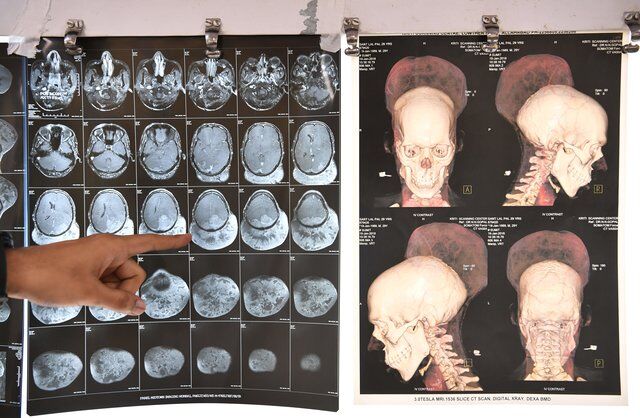 В Індії видалили пухлину мозку розміром майже з півголови