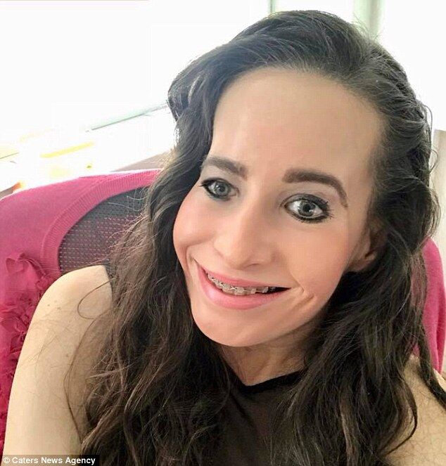 ''Найщасливіша в світі'': дівчина з половиною обличчя показала нові фото