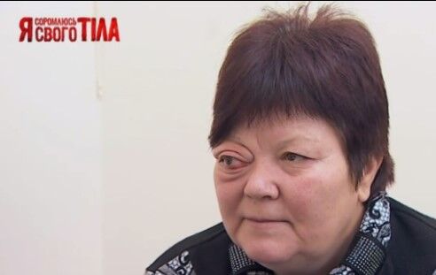 "Я соромлюсь свого тіла": як рятували око, яке випадає
