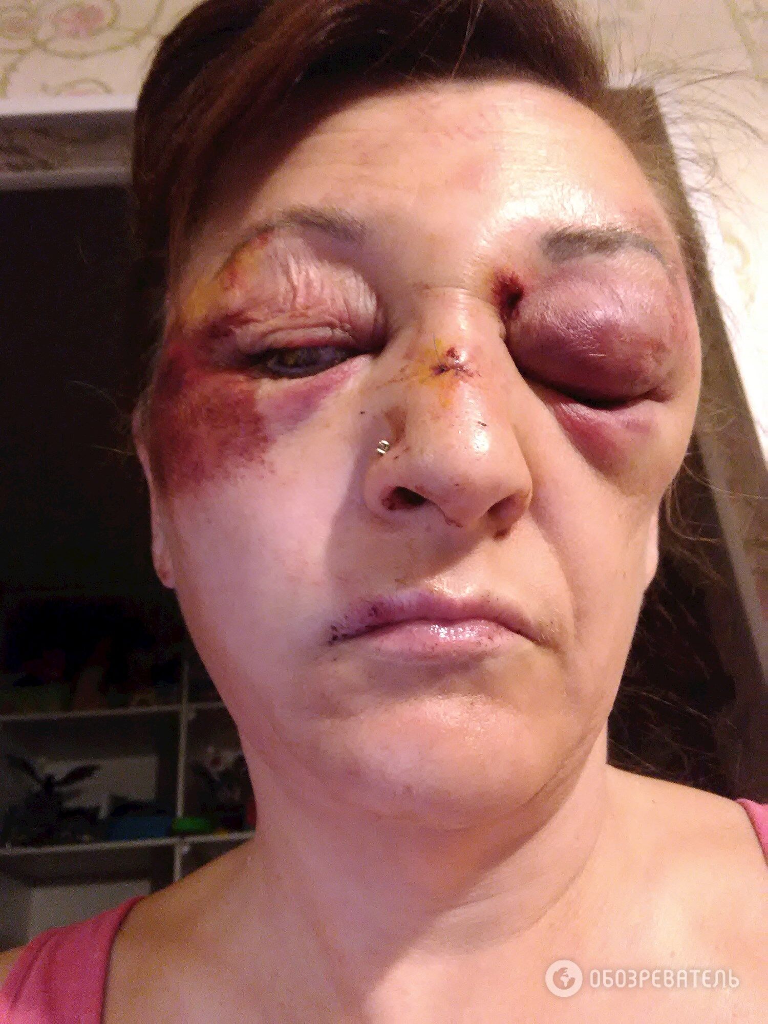Наталья Проценко после нападения