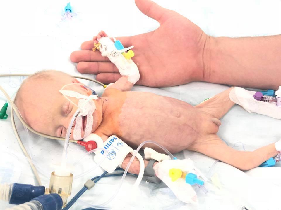 Ребенок весил килограмм: в Украине провели уникальную операцию на сердце