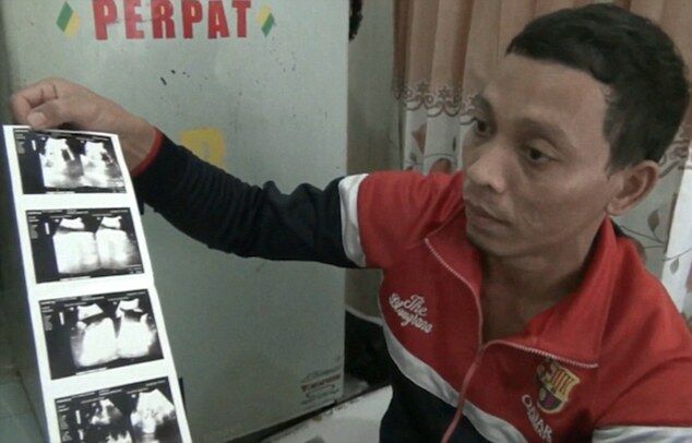 ''Поглинув'' свого брата: в Індонезії народився хлопчик із двома обличчями і парою мізків. Моторошні фото і відео