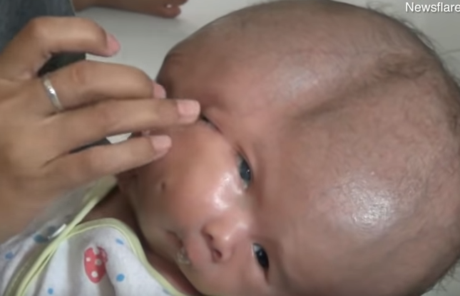 ''Поглинув'' свого брата: в Індонезії народився хлопчик із двома обличчями і парою мізків. Моторошні фото і відео