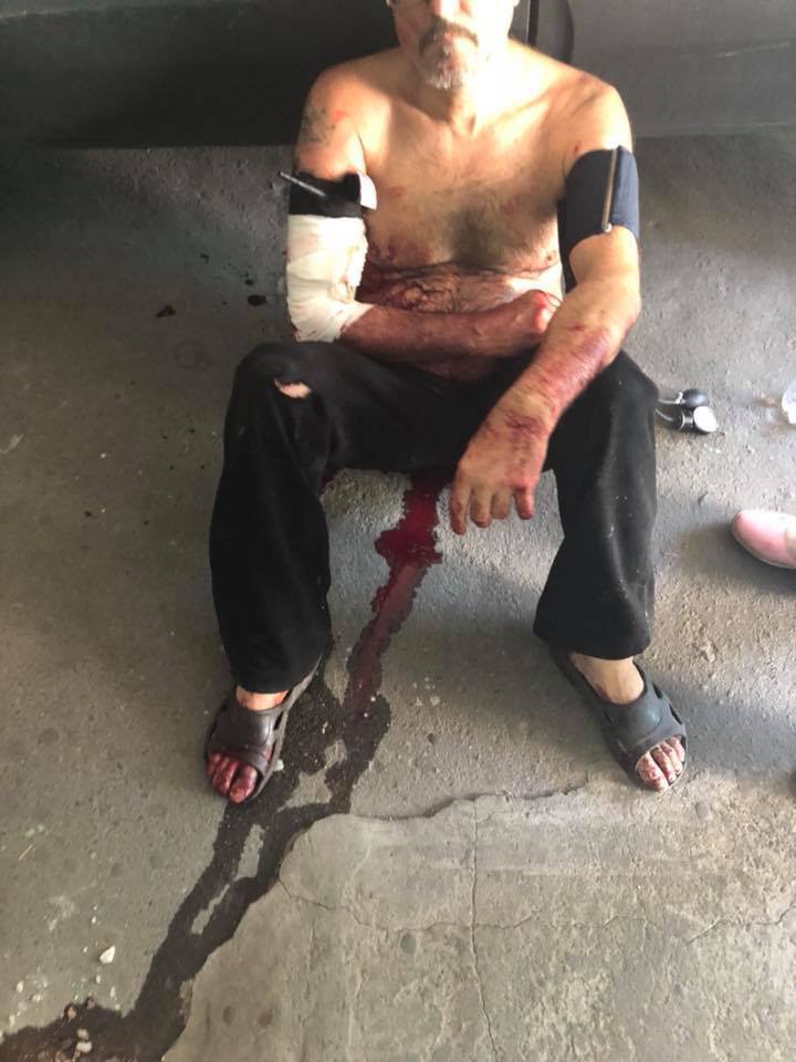 Разорвана рука, весь в крови: в Днепре врачи оскандалились, отказавшись спасать раненого