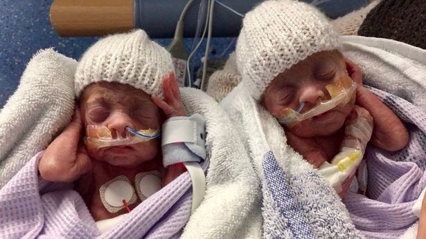 На этом сроке еще делают аборт: в Англии выжили близнецы размером с ладонь. Фоторепортаж