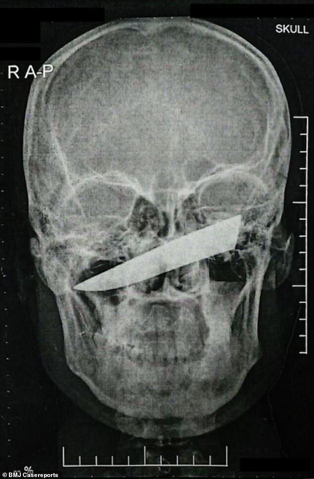 Залишився живий: африканець проходив із лезом ножа в оці 4 дні