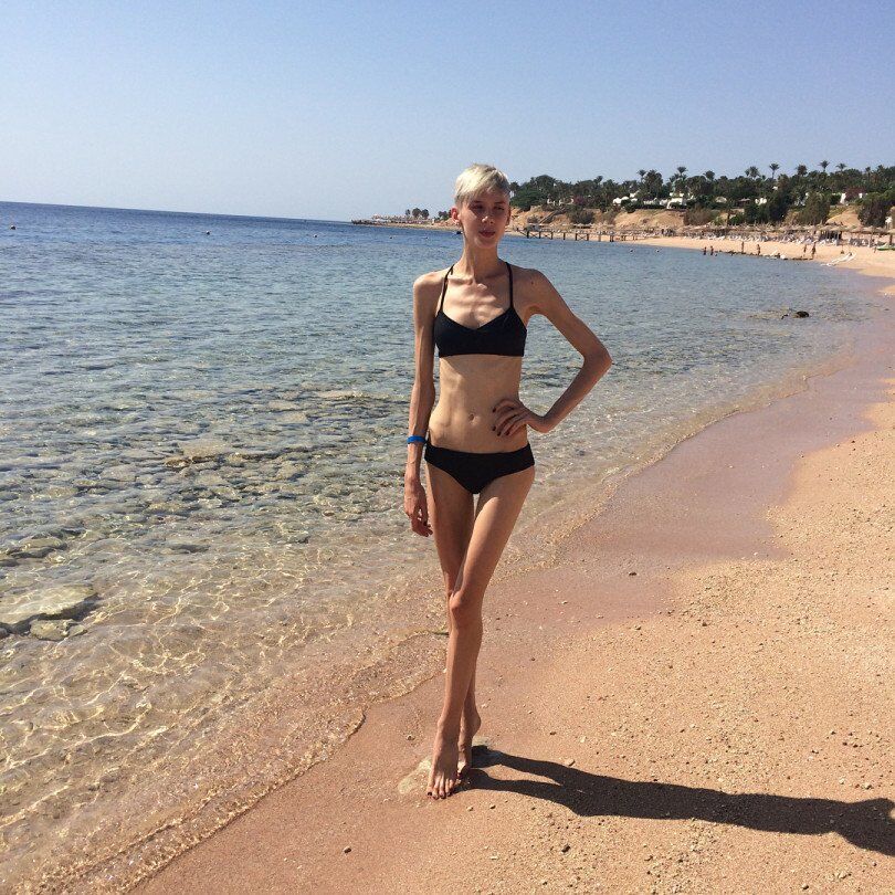  "На грани": победительница "Супермодели по-украински" рассказала о своей анорексии