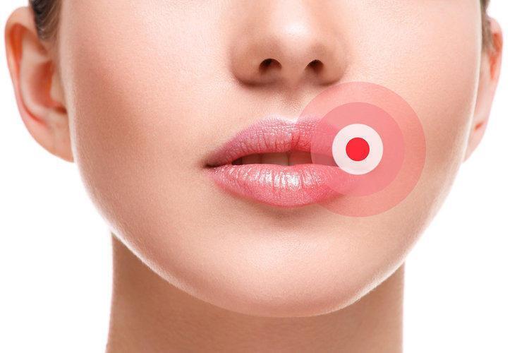 Научное открытие поможет избавиться от герпетических пузырьков на губах