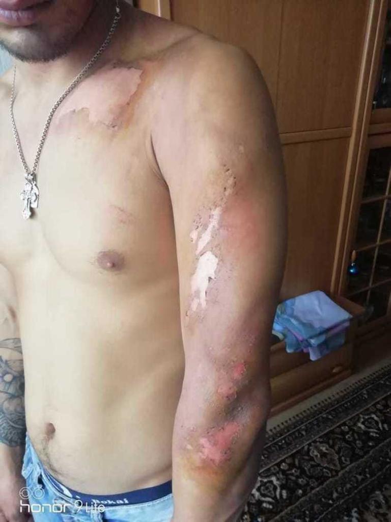 "Душили, лили окріп і різали": в Росії п'яні силовики катували невинуватого хлопця. Фото і відео 18+