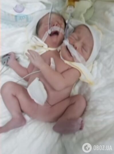 Перше фото сіамських близнюків