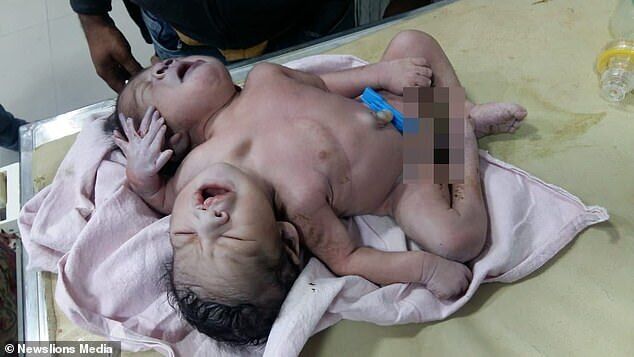 В Індії народилися рідкісні сіамські близнюки