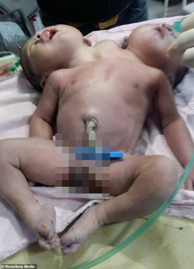 В Індії народилася дитина з двома головами і трьома руками