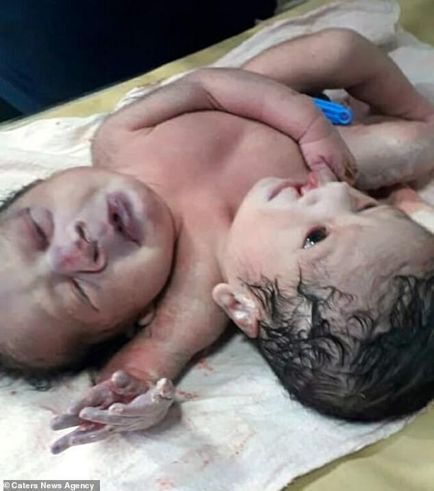 В Індії народилася дитина з двома головами і трьома руками