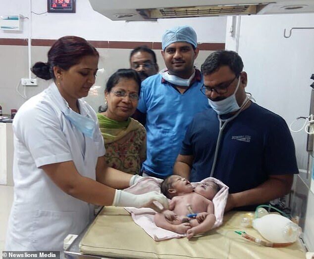 В Индии родился ребенок с двумя головами