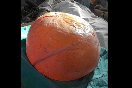 В Индии врачи удалили опухоль весом 18 килограммов из яичника 38-летней женщины