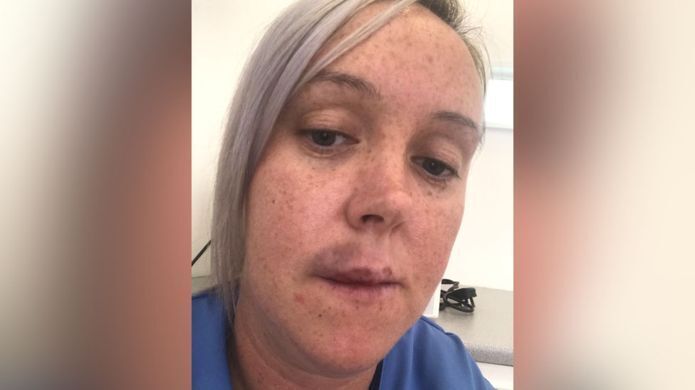 Після ін'єкції у неї почалося омертвіння шкіри обличчя