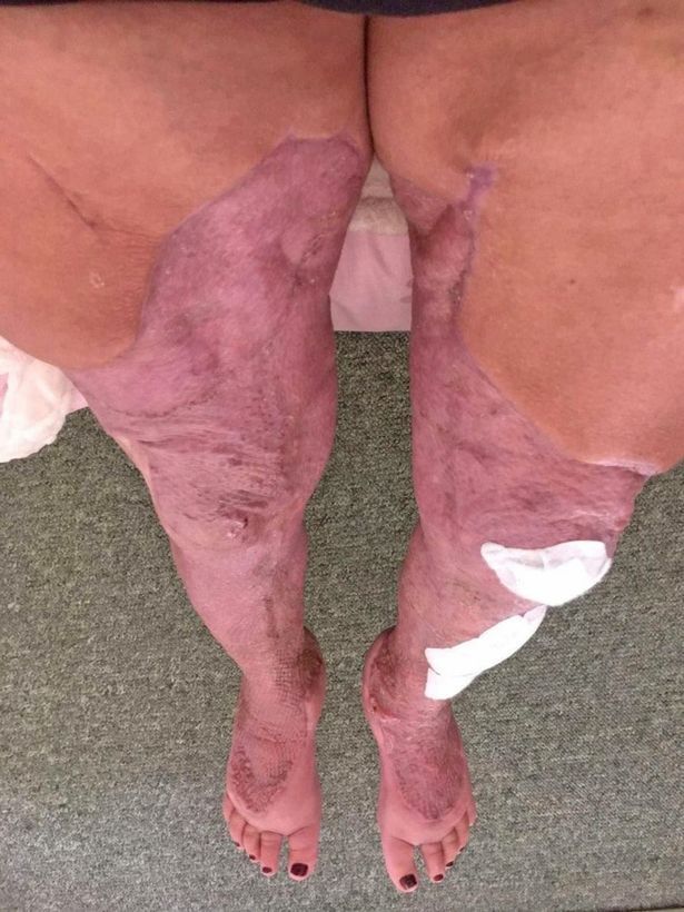 Ноги Джейни Насименто после операции