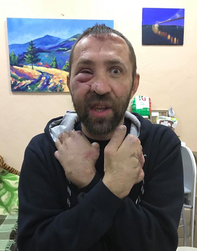 Український боєць Богдан отримав важкі поранення на Донбасі