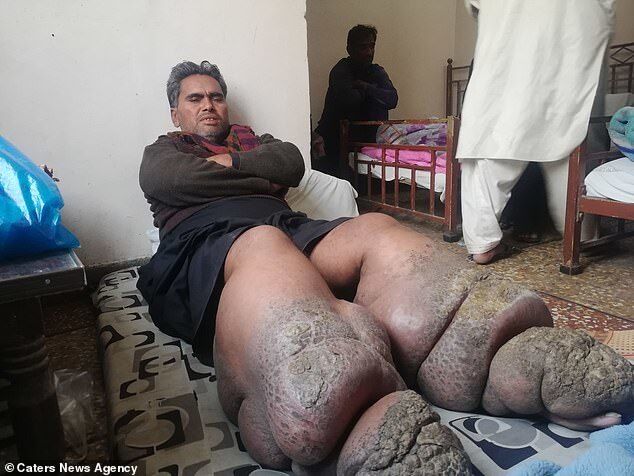 Ноги чоловіка роздуло до гігантських розмірів: моторошні фото