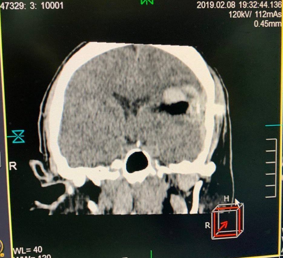 Операция по лезвию ножа: в Днепре врачи спасли бойца с прорубленным осколком мозгом
