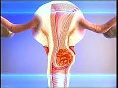 Предупреждение возникновения раковых заболеваний женских половых органов.