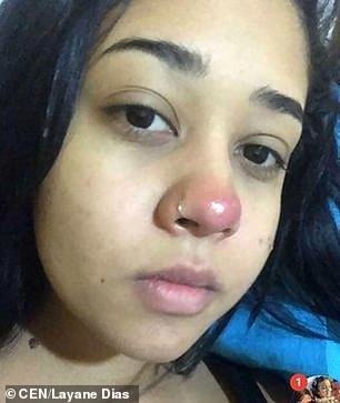 В инвалидной коляске навсегда: в Бразилии пирсинг носа парализовал девушку 