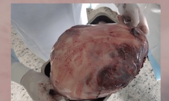 Шрам на півспини: українця вбивала 3-кілограмова пухлина-монстр. Фото 18+