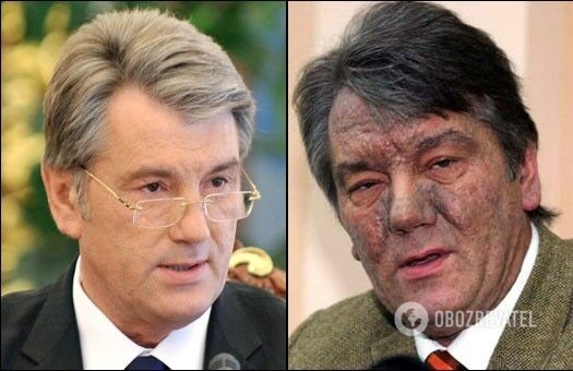 Наслідки отруєння екс-президента Віктора Ющенка