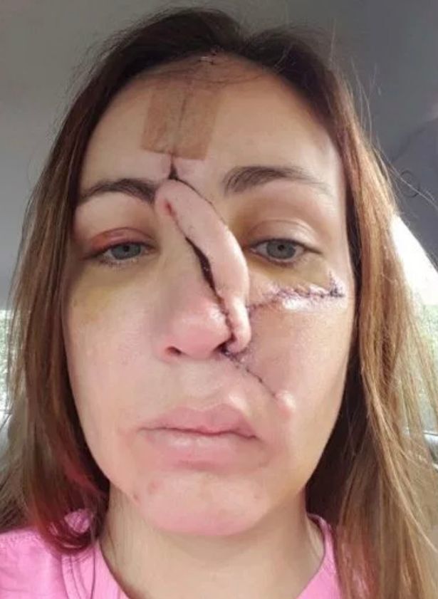 30 років росла пухлина: американка позбулася носа через безневинну пляму