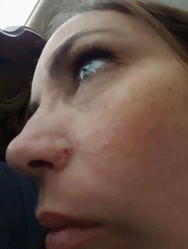 30 років росла пухлина: американка позбулася носа через безневинну пляму