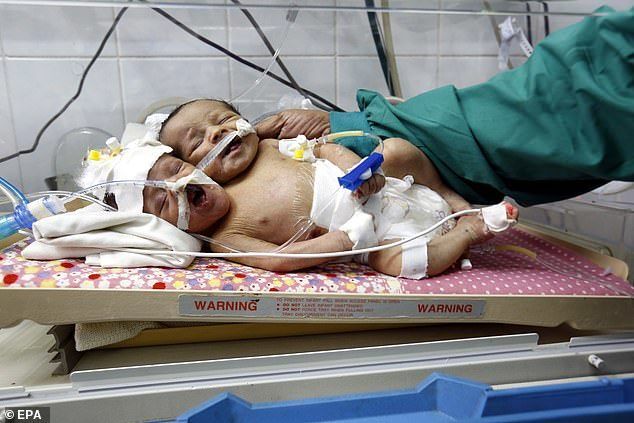 Одне тіло на двох: у Ємені народилися рідкісні сіамські близнюки