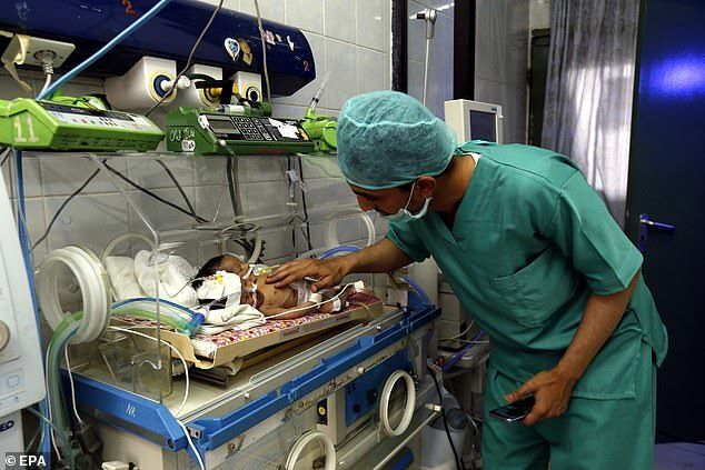 Одно тело на двоих: в Йемене родились редкие сиамские близнецы