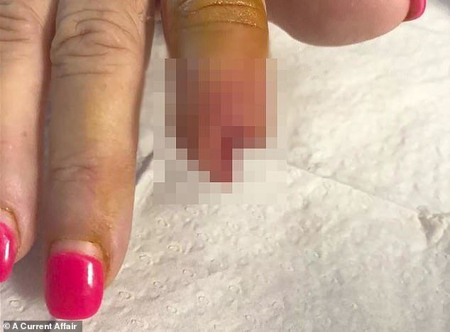  Пять операций подряд: женщина лишилась фаланги пальца из-за маникюра