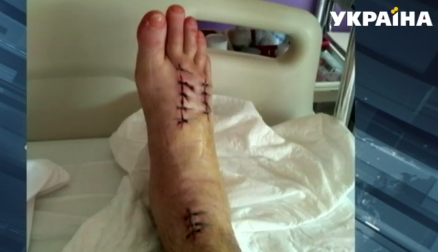 Так сейчас выглядит нога пострадавшего