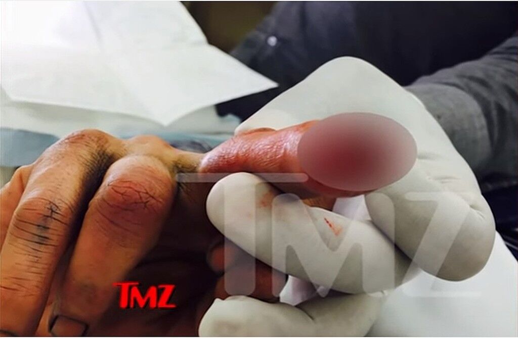 Жена отрезала палец: появилось фото тяжелой травмы Джонни Деппа