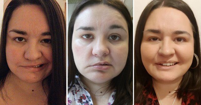У женщины парализовало лицо из-за нервной работы: какие симптомы