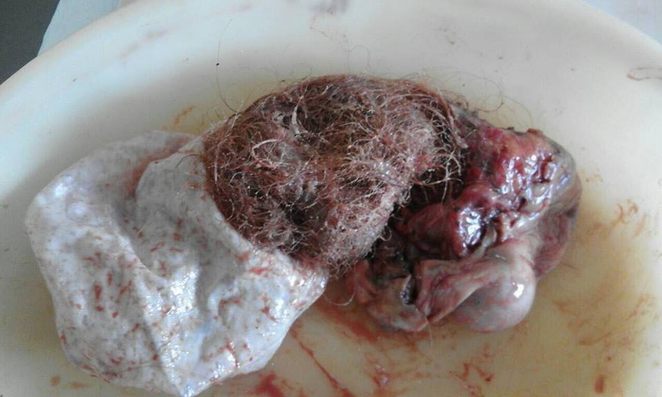 Жмутки волосся і зуби: українці вирізали пухлину з жахливою ''начинкою''. Фото 18+